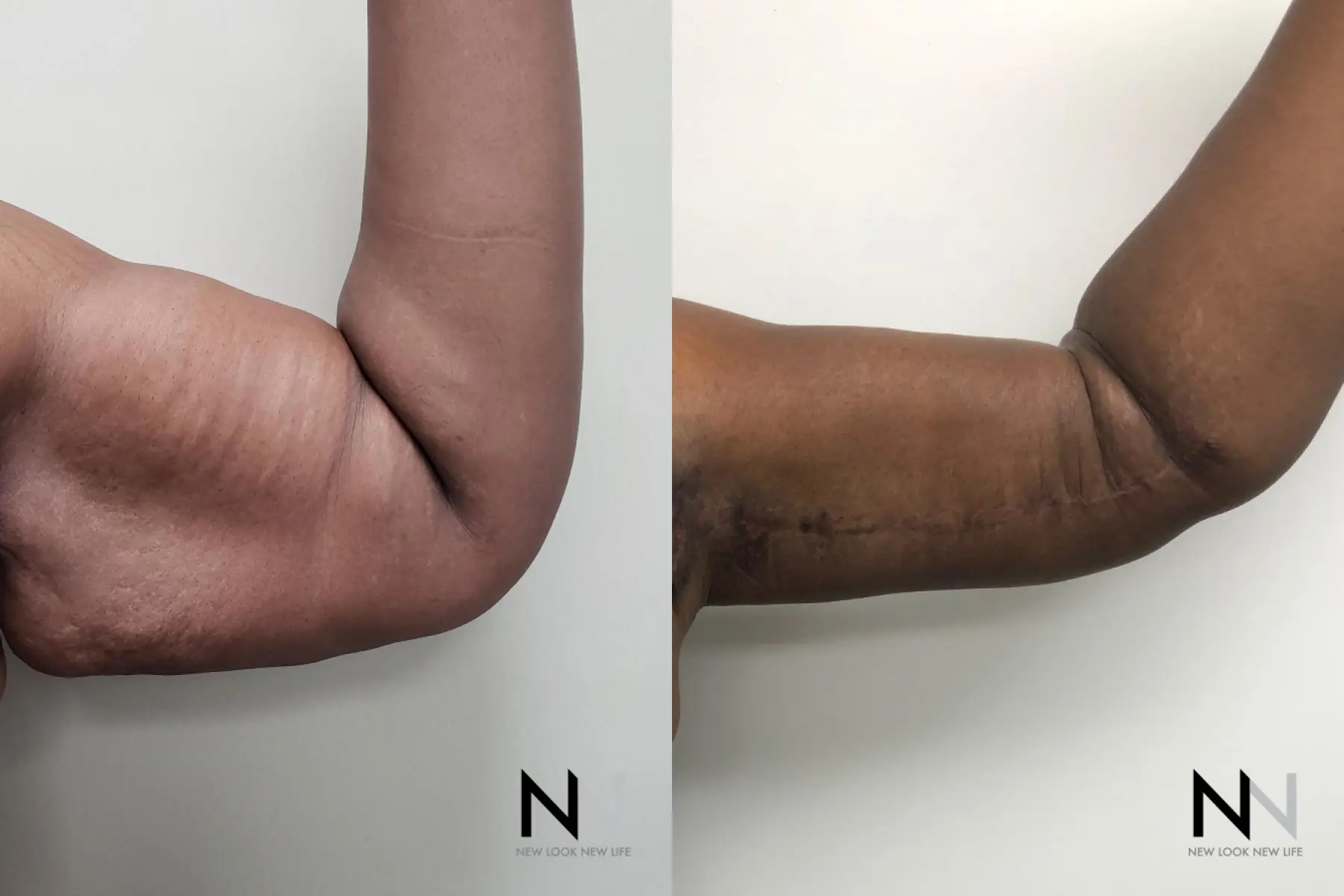 Arm Lift: Patient 9 - Before and After 4