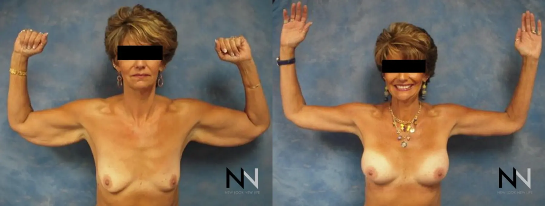 Arm Lift: Patient 3 - Before and After 2