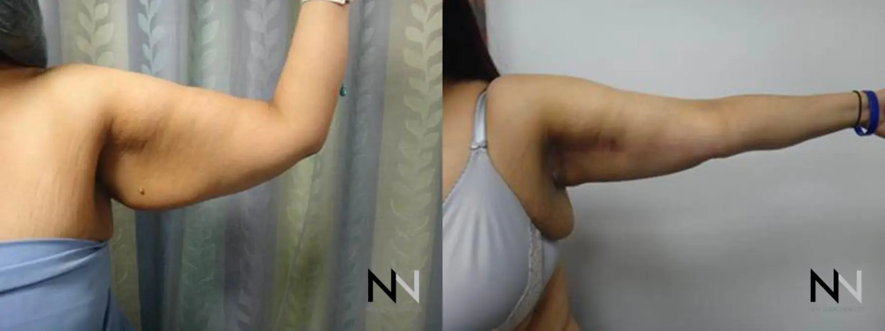 Arm Lift: Patient 4 - Before and After  