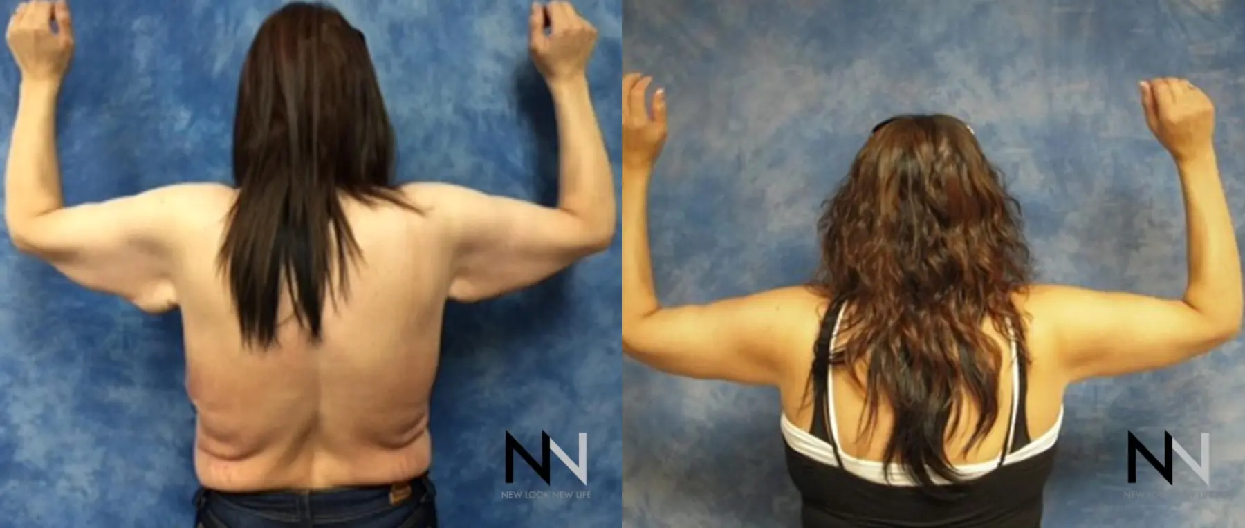 Arm Lift: Patient 10 - Before and After 2