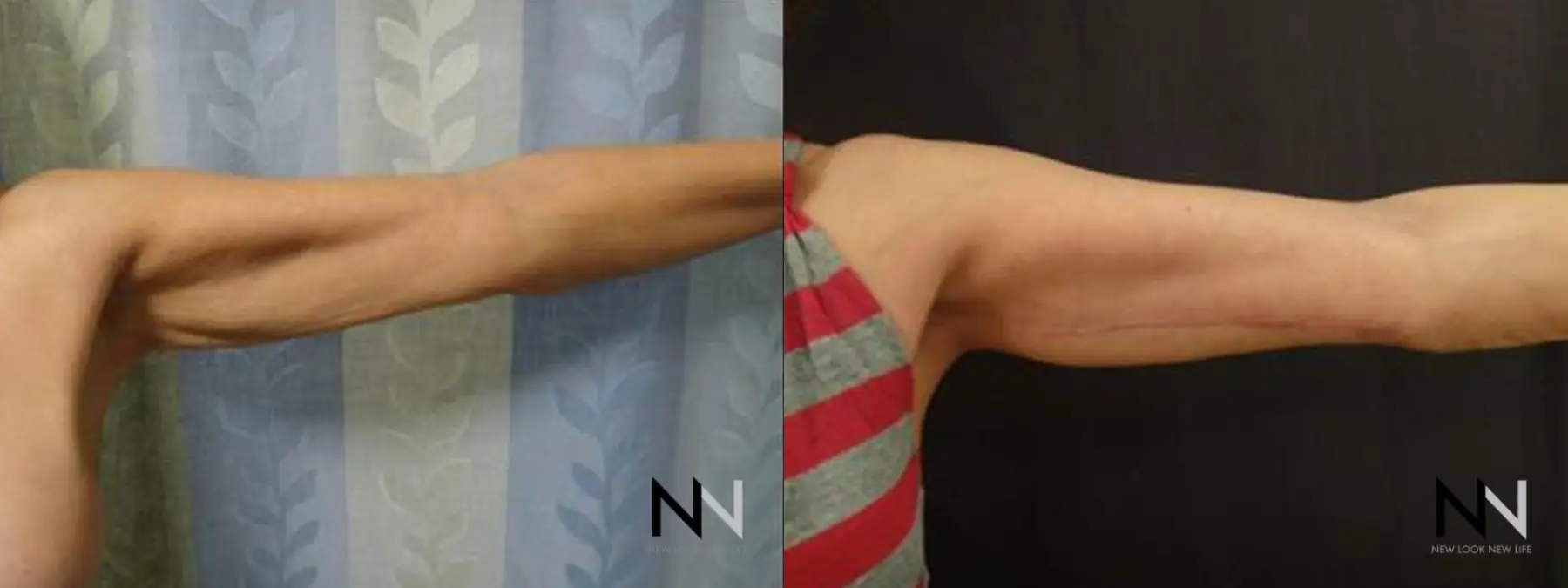 Arm Lift: Patient 8 - Before and After 2