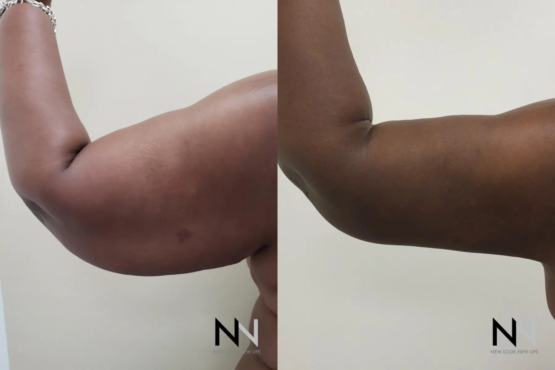 Arm Lift: Patient 9 - Before and After  