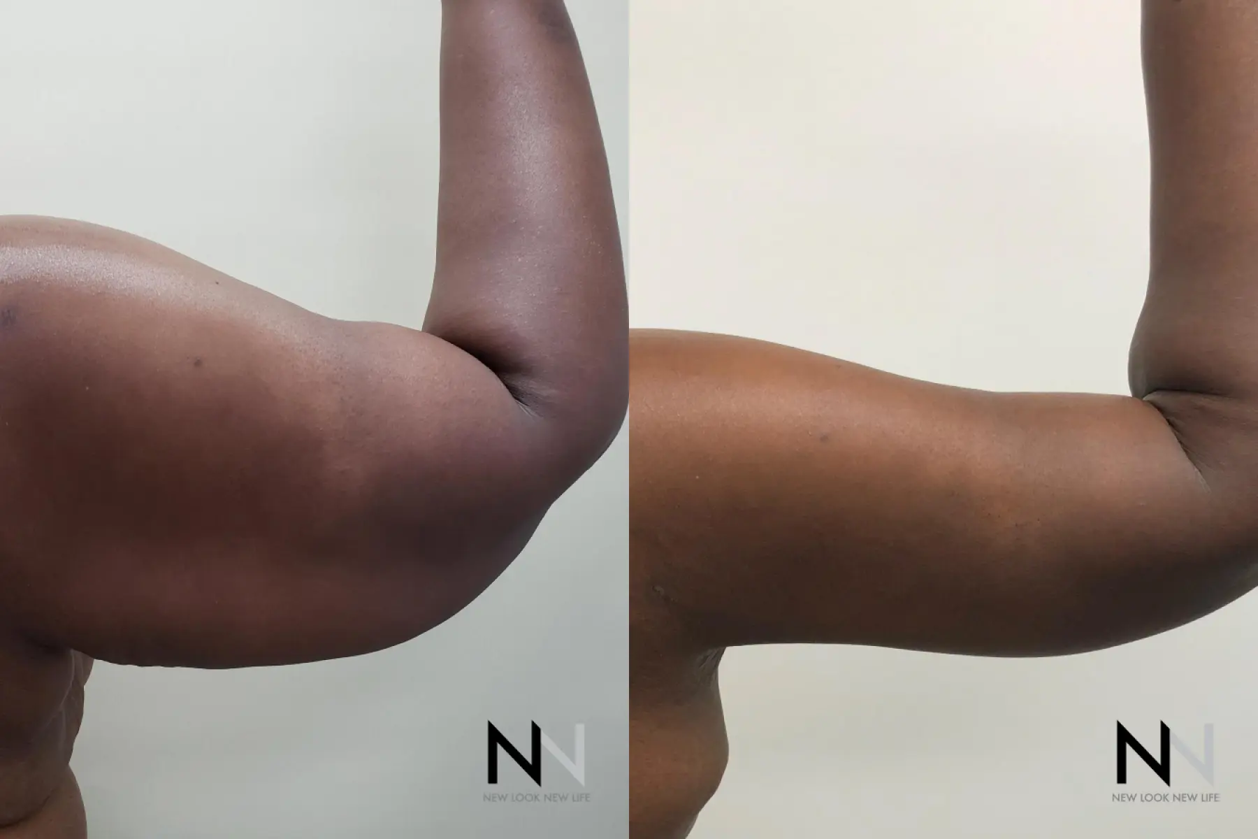 Arm Lift: Patient 9 - Before and After 2