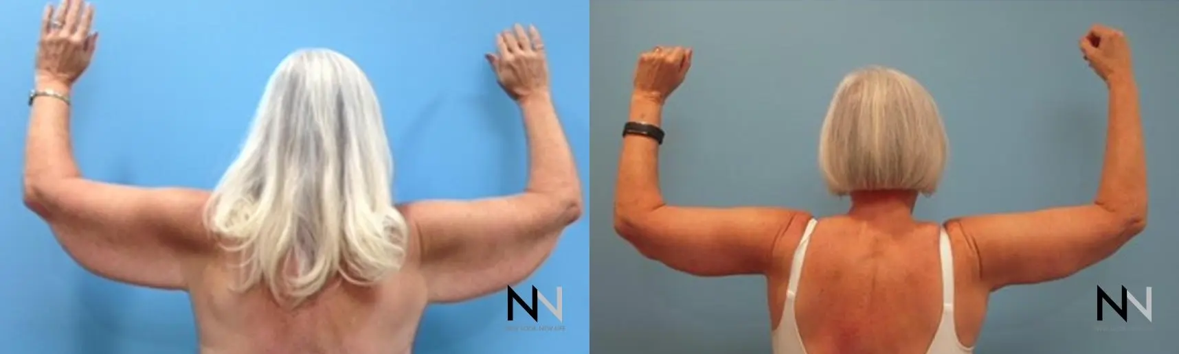 Arm Lift: Patient 11 - Before and After 2