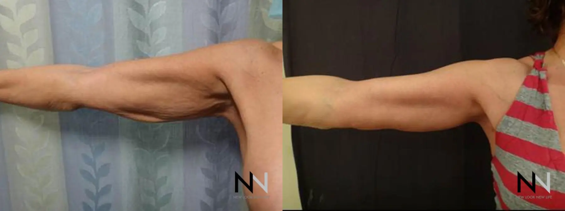 Arm Lift: Patient 8 - Before and After  