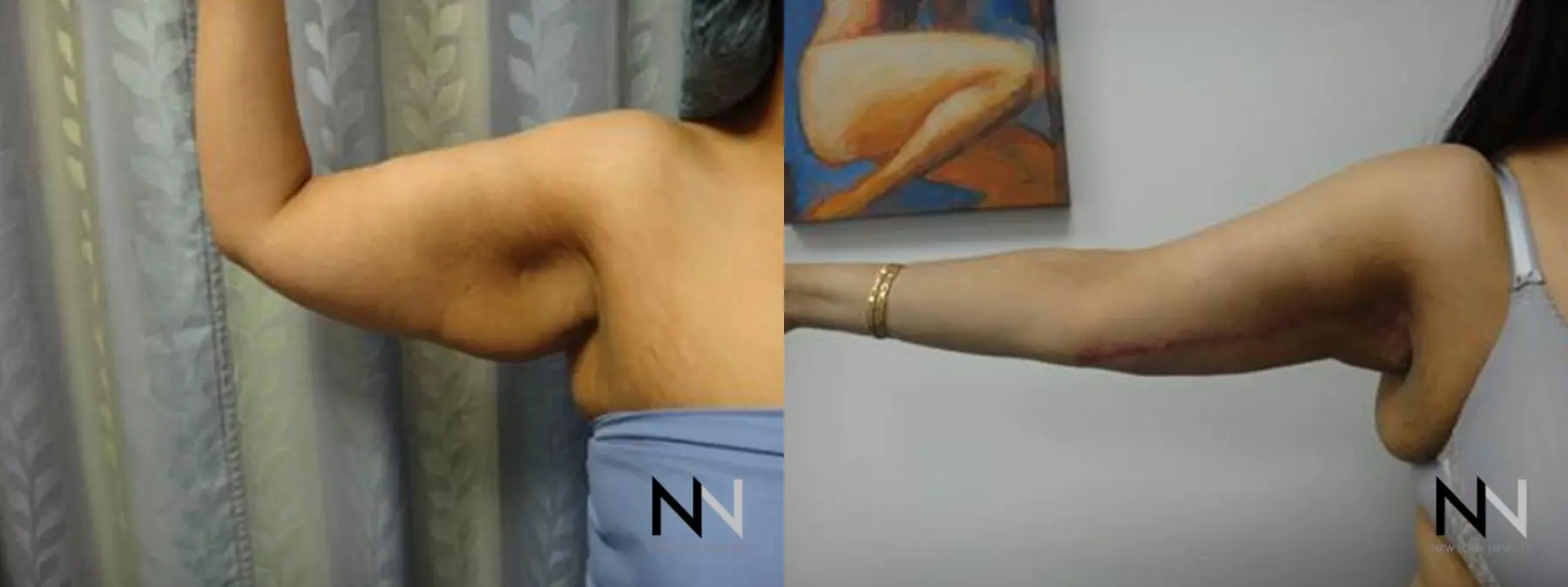 Arm Lift: Patient 4 - Before and After 2