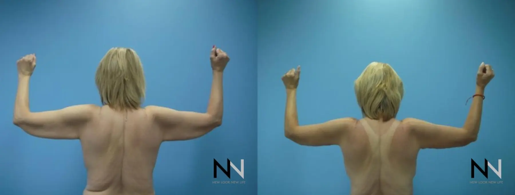 Arm Lift: Patient 7 - Before and After  