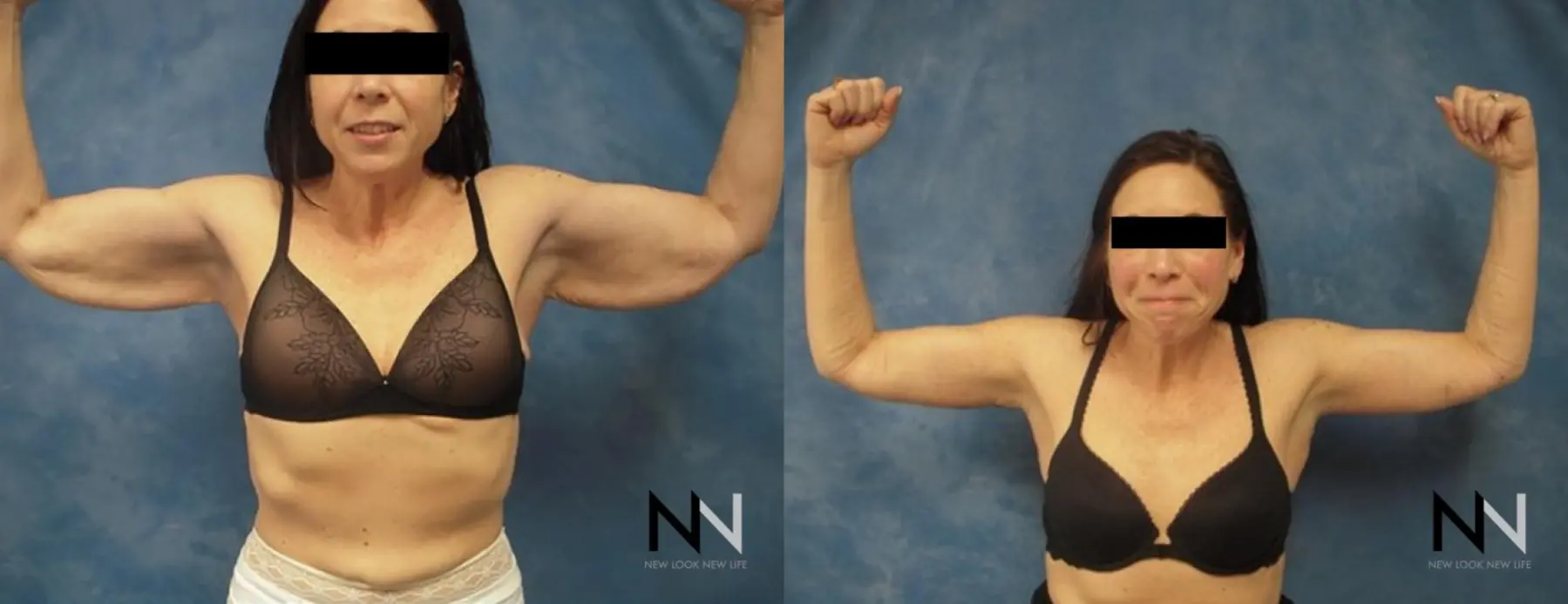 Arm Lift: Patient 5 - Before and After  