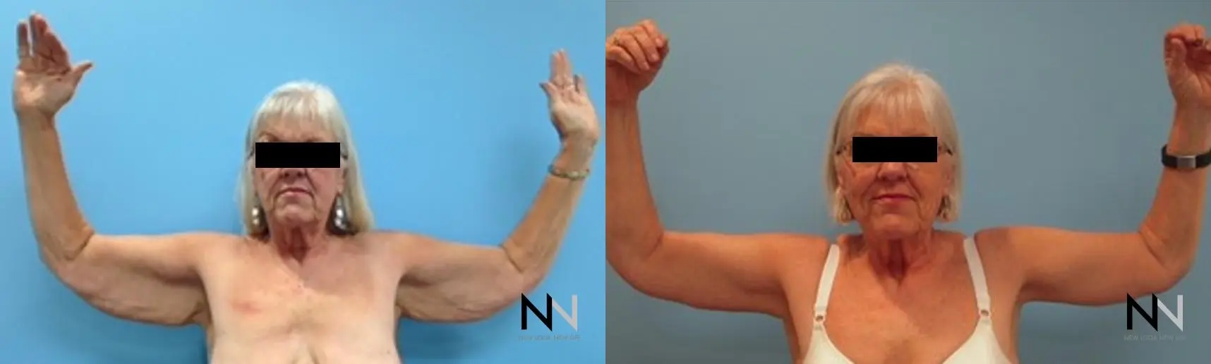 Arm Lift: Patient 11 - Before and After 1