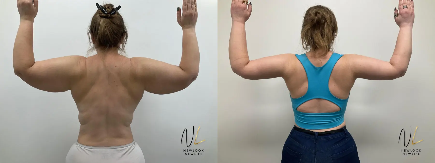 Arm Lift: Patient 2 - Before and After  