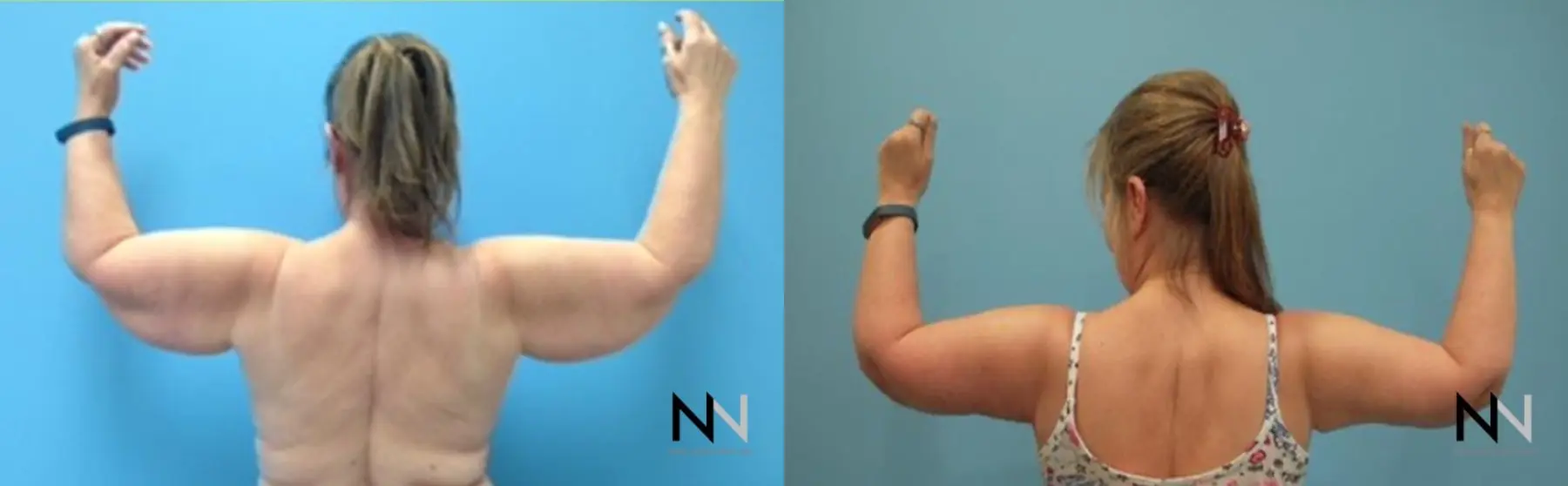 Arm Lift: Patient 6 - Before and After 2