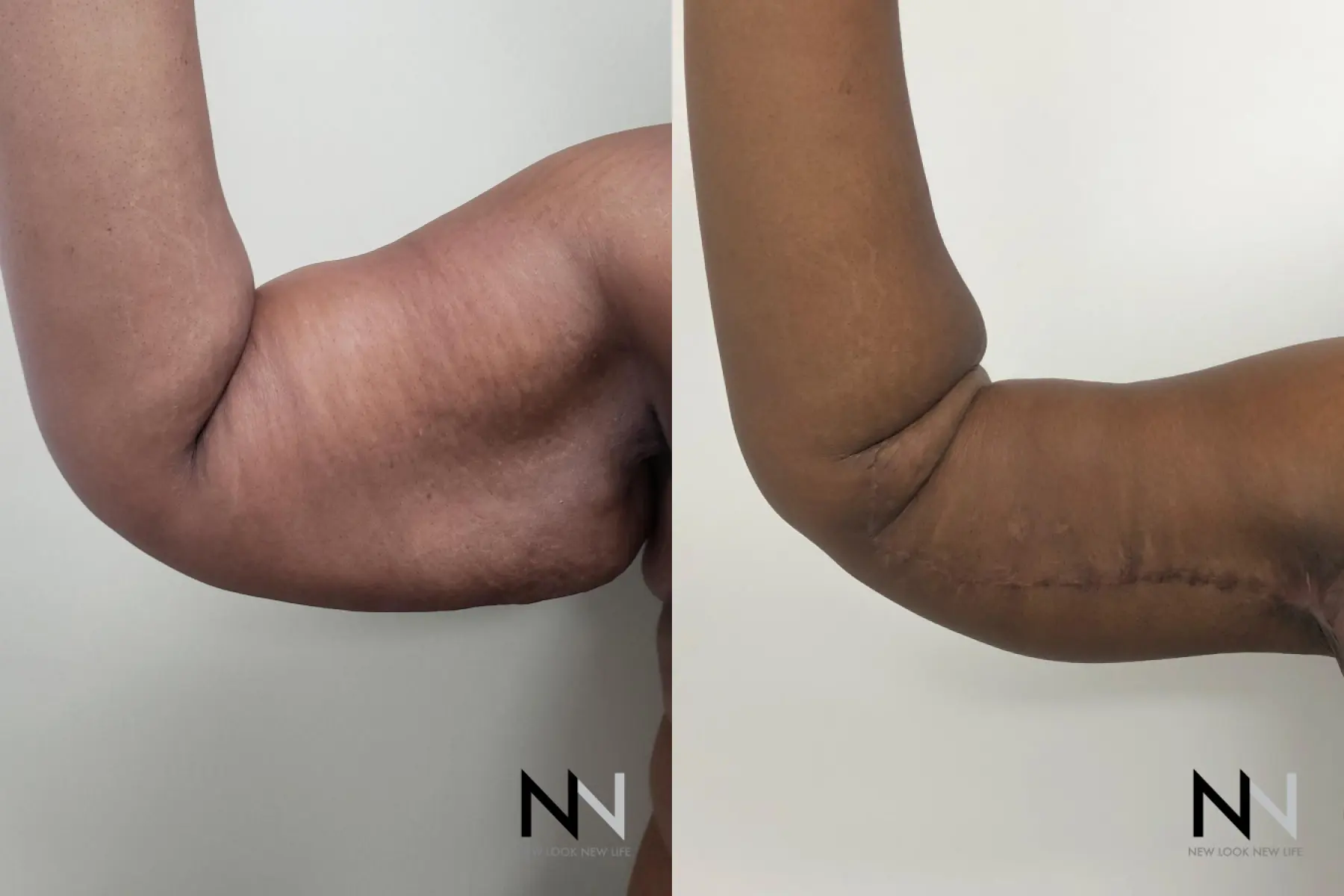 Arm Lift: Patient 9 - Before and After 3