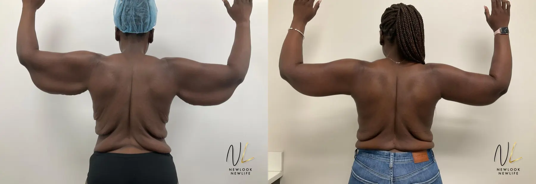 Arm Lift: Patient 1 - Before and After  