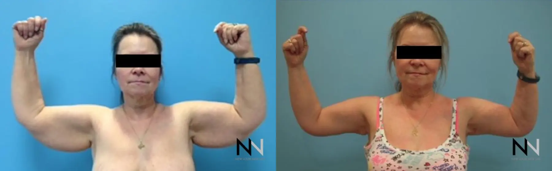 Arm Lift: Patient 6 - Before and After  