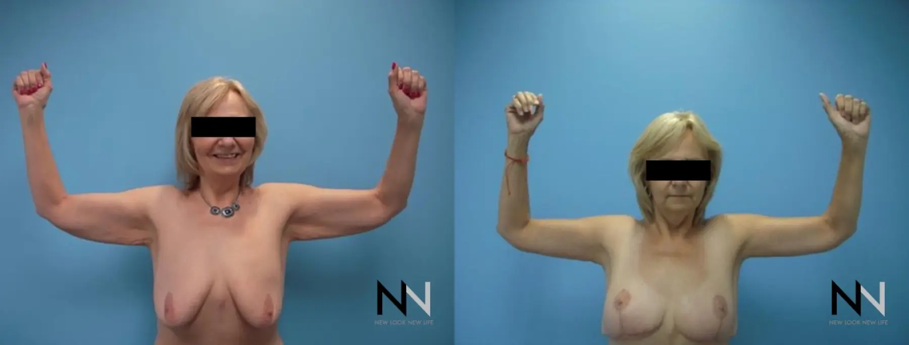 Arm Lift: Patient 7 - Before and After 2