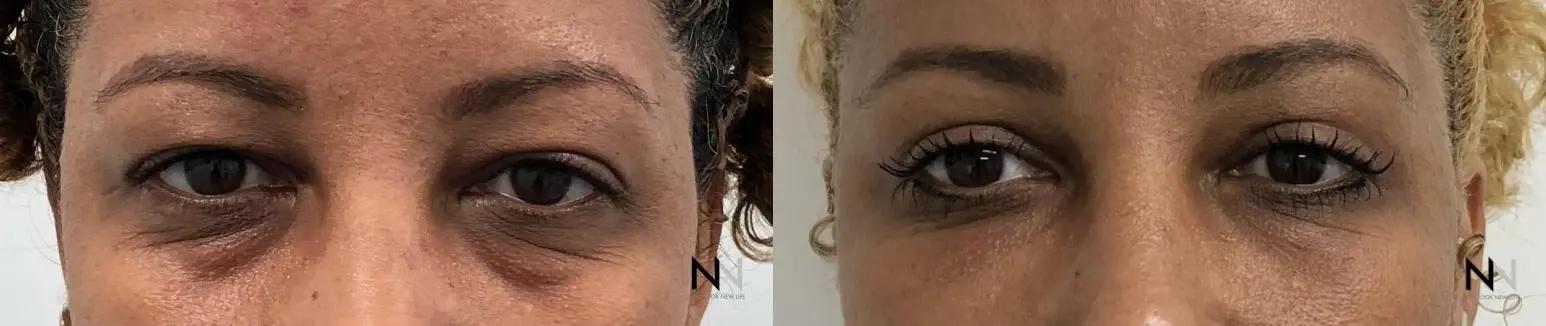 Blepharoplasty: Patient 1 - Before and After  