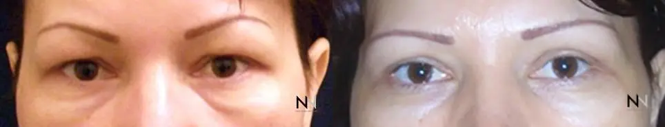 Blepharoplasty: Patient 3 - Before and After  