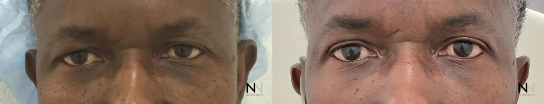 Blepharoplasty: Patient 4 - Before and After  