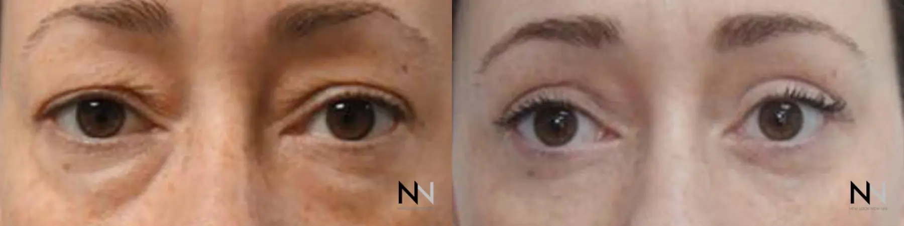 Blepharoplasty: Patient 8 - Before and After  