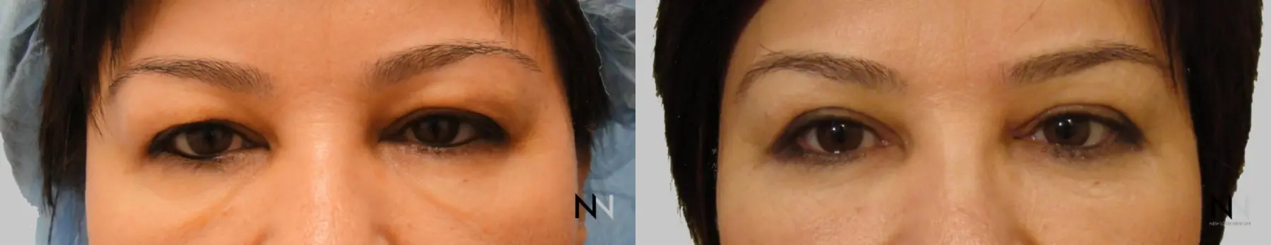 Blepharoplasty: Patient 5 - Before and After  