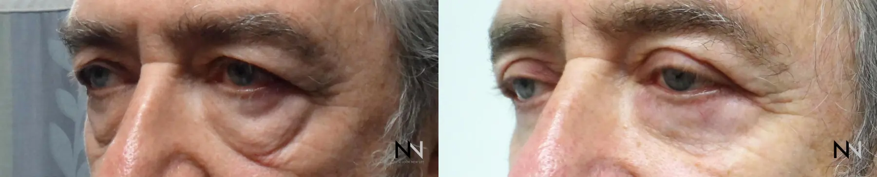 Blepharoplasty: Patient 7 - Before and After  