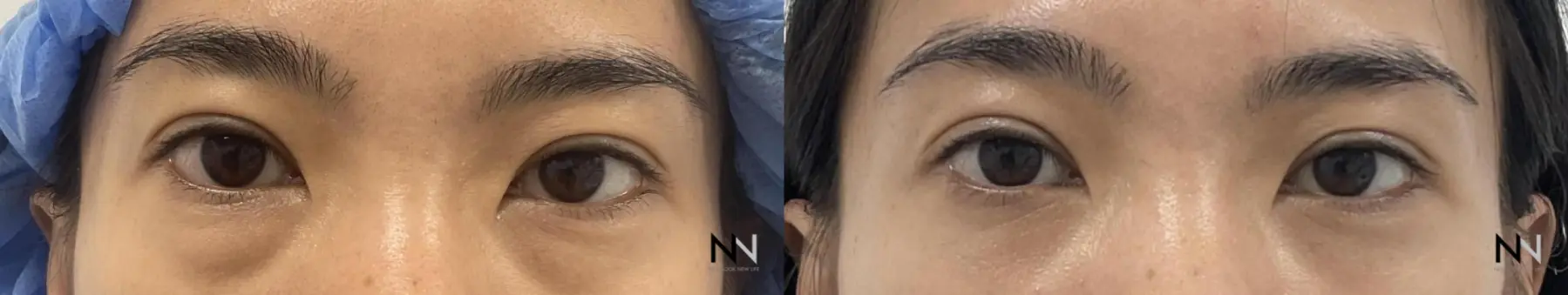 Blepharoplasty: Patient 9 - Before and After  