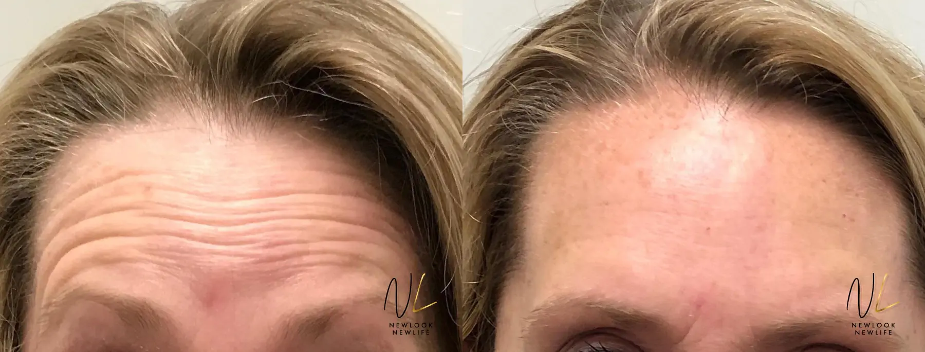 Botox And Dysport: Patient 17 - Before and After 1