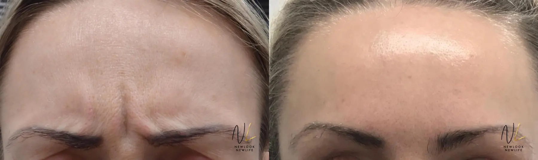 Botox And Dysport: Patient 13 - Before and After 1