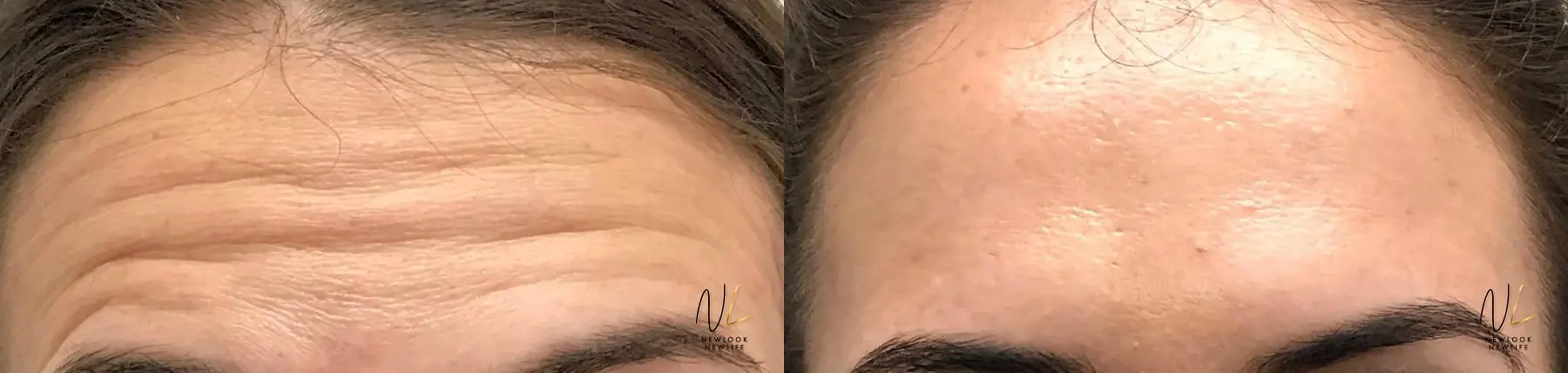 Botox And Dysport: Patient 15 - Before and After 1