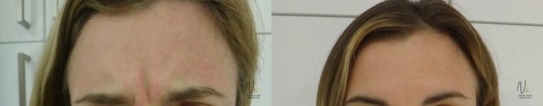 Botox And Dysport: Patient 10 - Before and After  