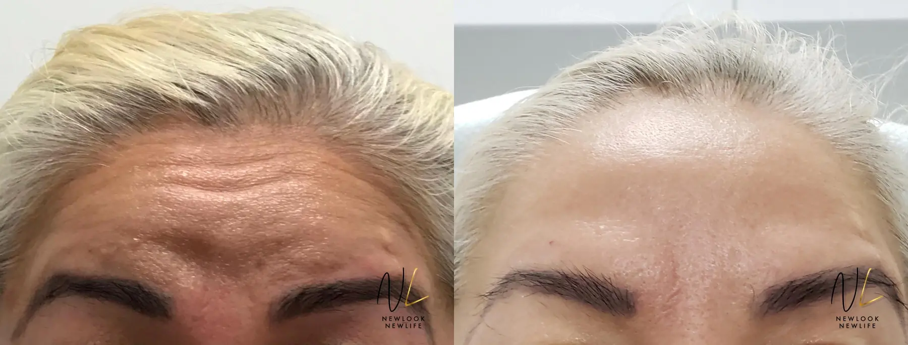 Botox And Dysport: Patient 1 - Before and After 1