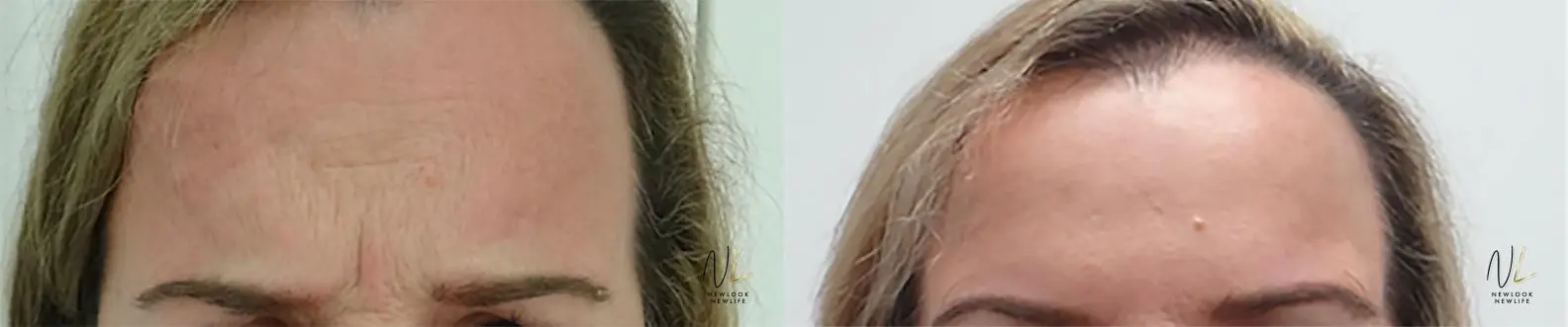 Botox And Dysport: Patient 19 - Before and After 1