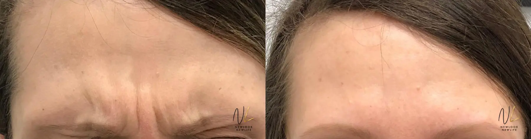 Botox And Dysport: Patient 3 - Before and After 1