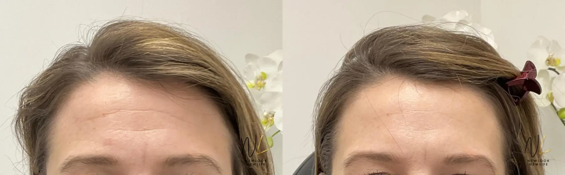 Botox And Dysport: Patient 25 - Before and After 1