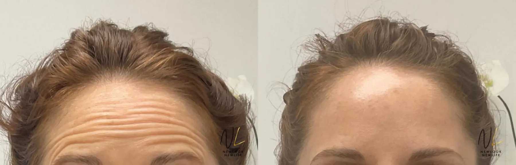 Botox And Dysport: Patient 24 - Before and After 1