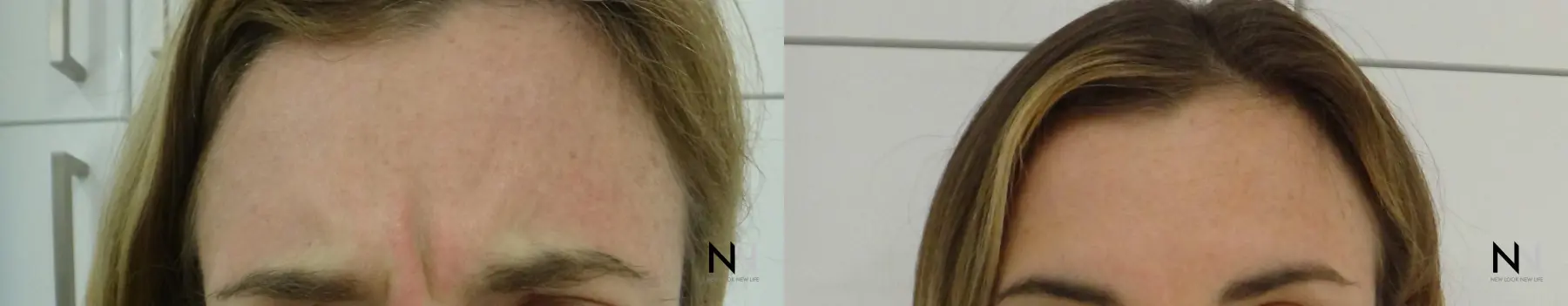 Botox And Dysport: Patient 10 - Before and After  