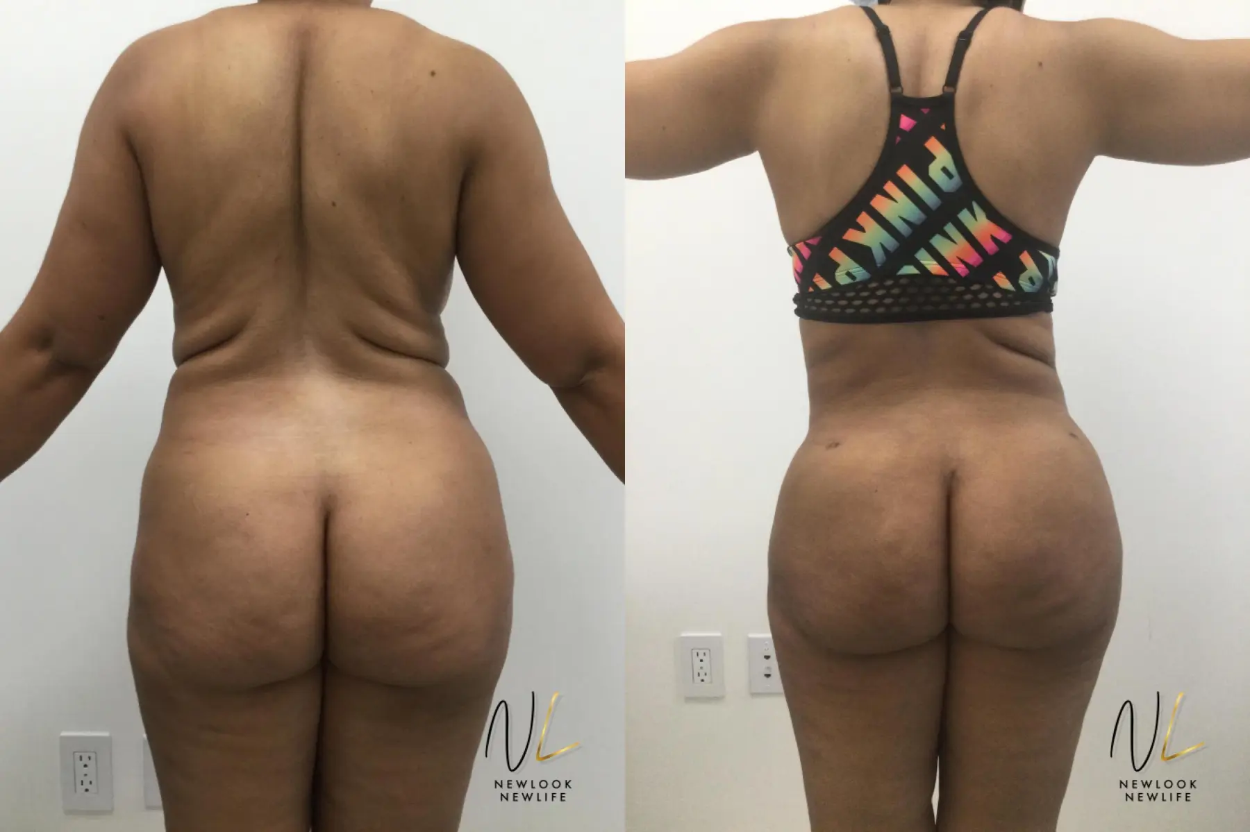 Brazilian Butt Lift: Patient 2 - Before and After  