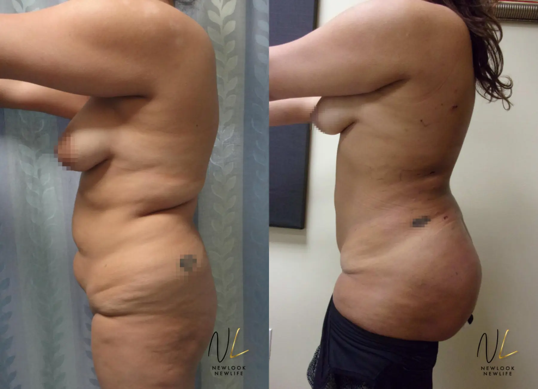 Brazilian Butt Lift: Patient 11 - Before and After 2