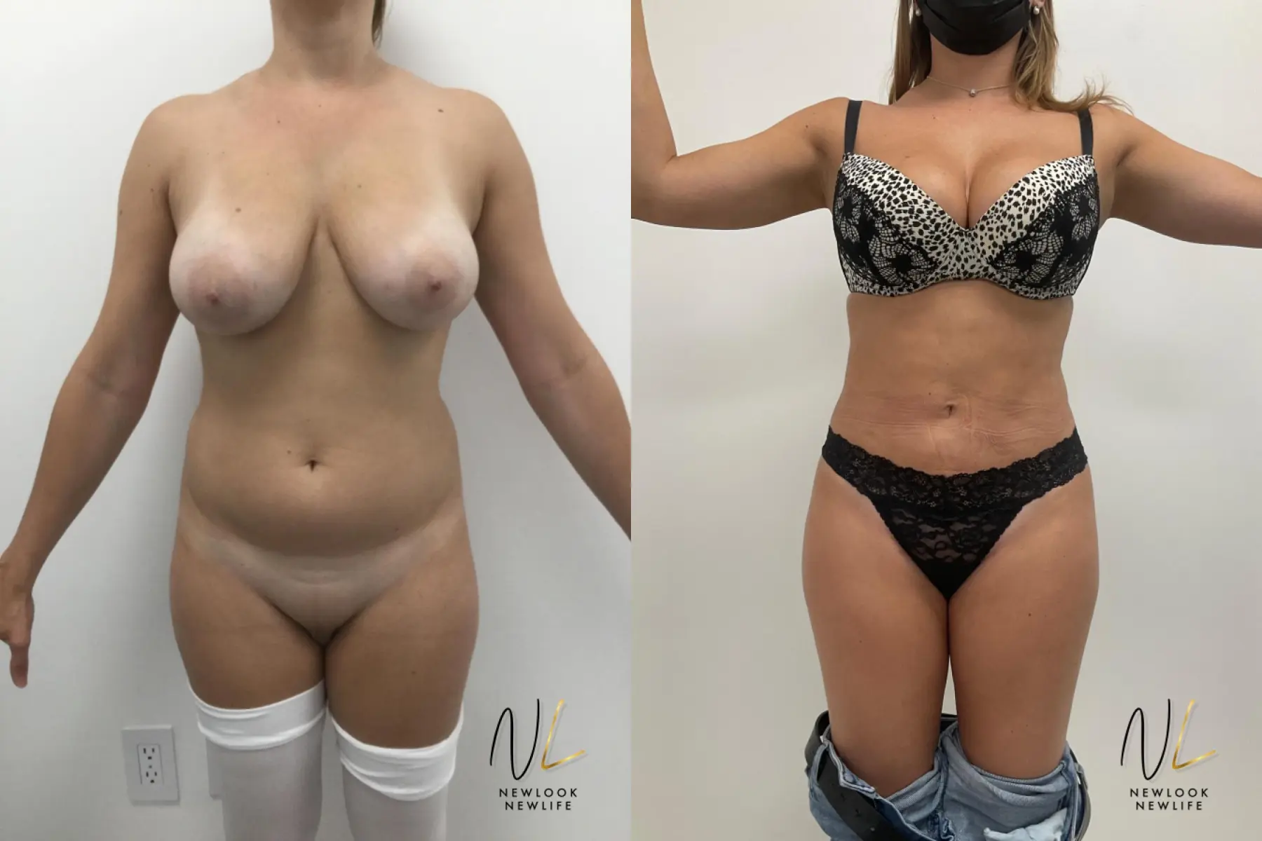 Brazilian Butt Lift: Patient 5 - Before and After 1