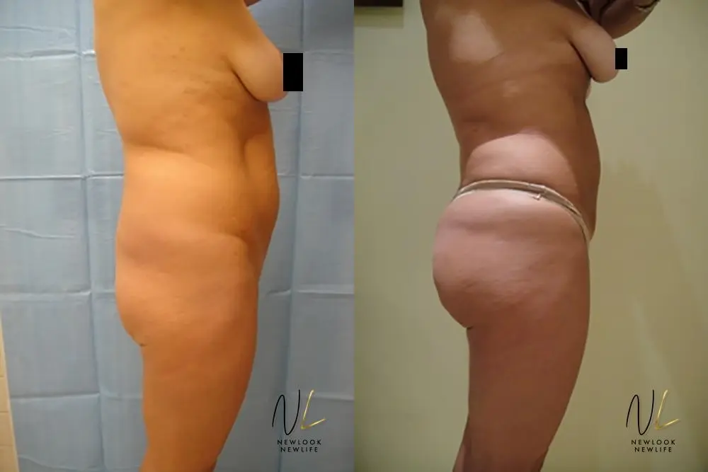 Brazilian Butt Lift: Patient 10 - Before and After 2