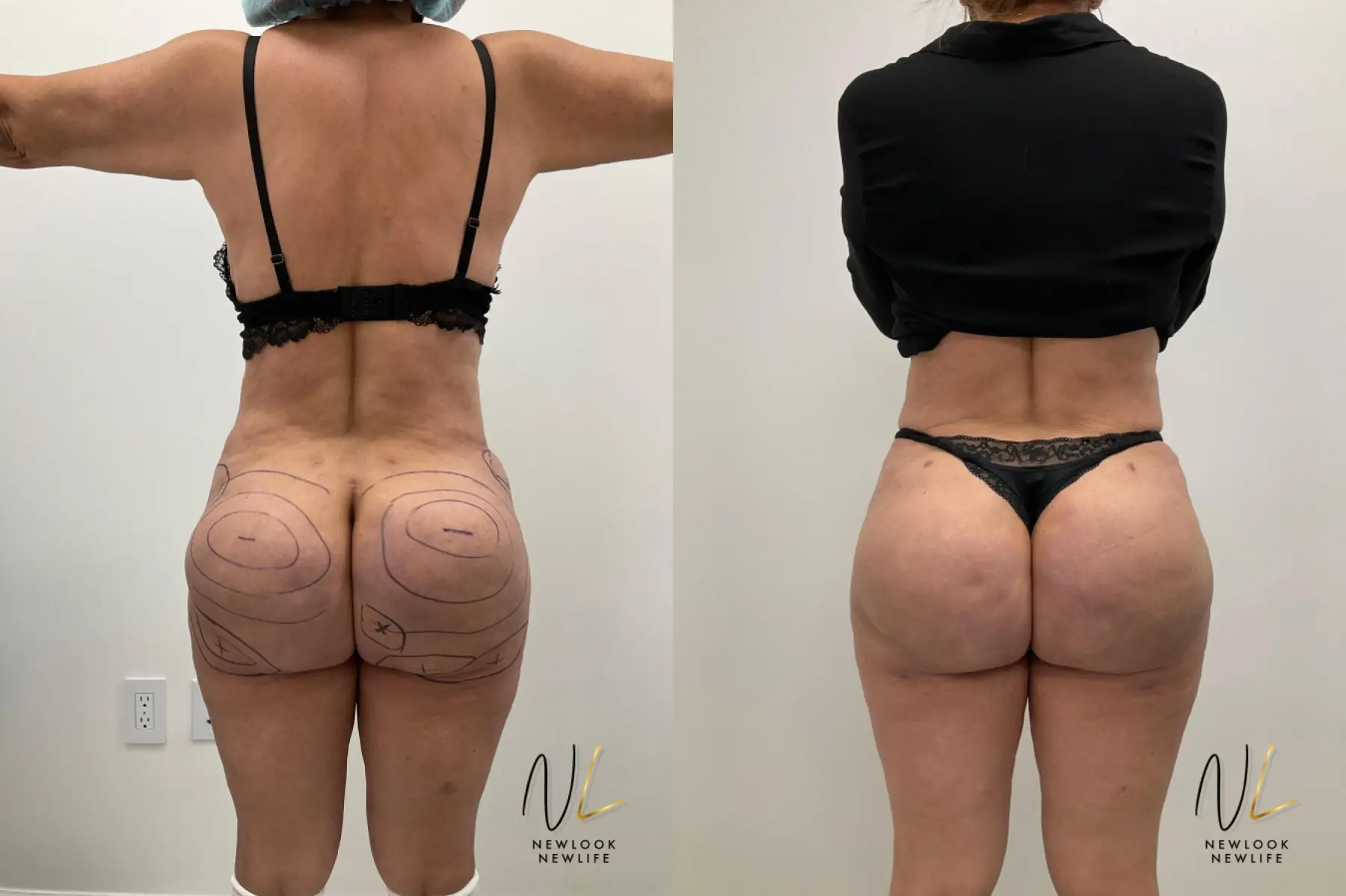 Brazilian Butt Lift: Patient 2 - Before and After  