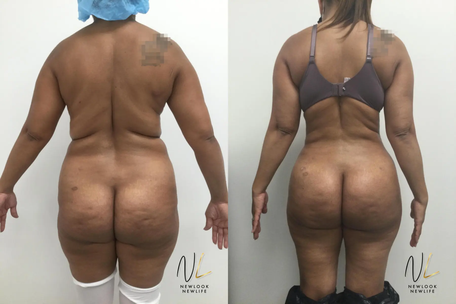 Brazilian Butt Lift: Patient 1 - Before and After 1