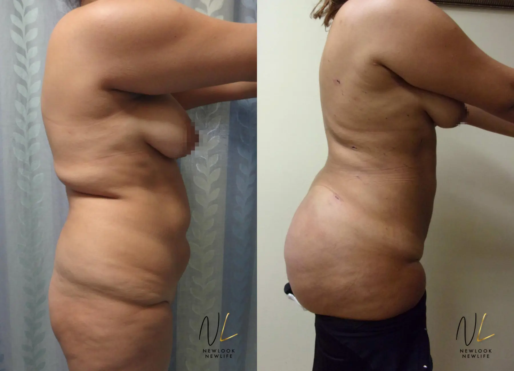 Brazilian Butt Lift: Patient 11 - Before and After 3