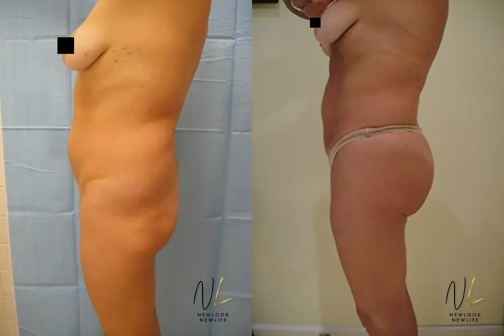 Brazilian Butt Lift: Patient 10 - Before and After 1