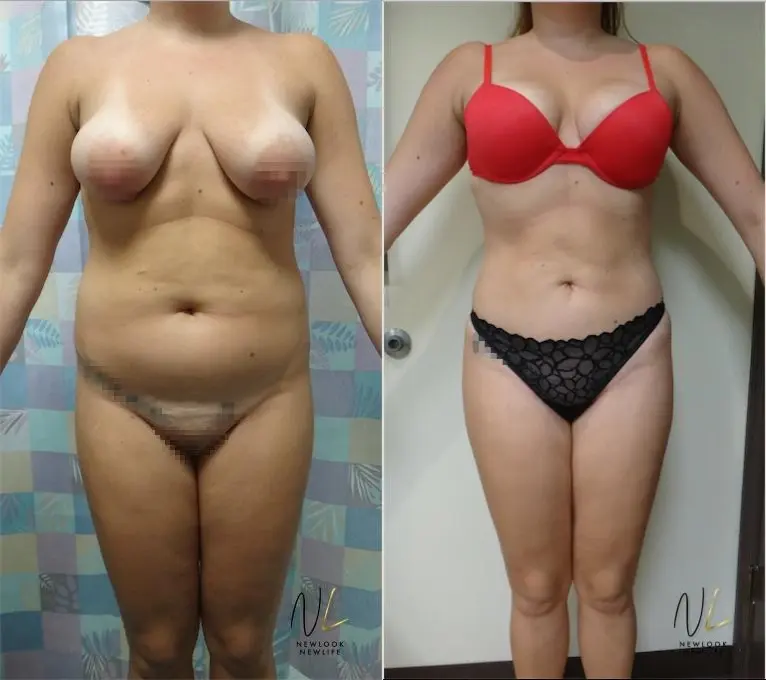 Brazilian Butt Lift: Patient 7 - Before and After  