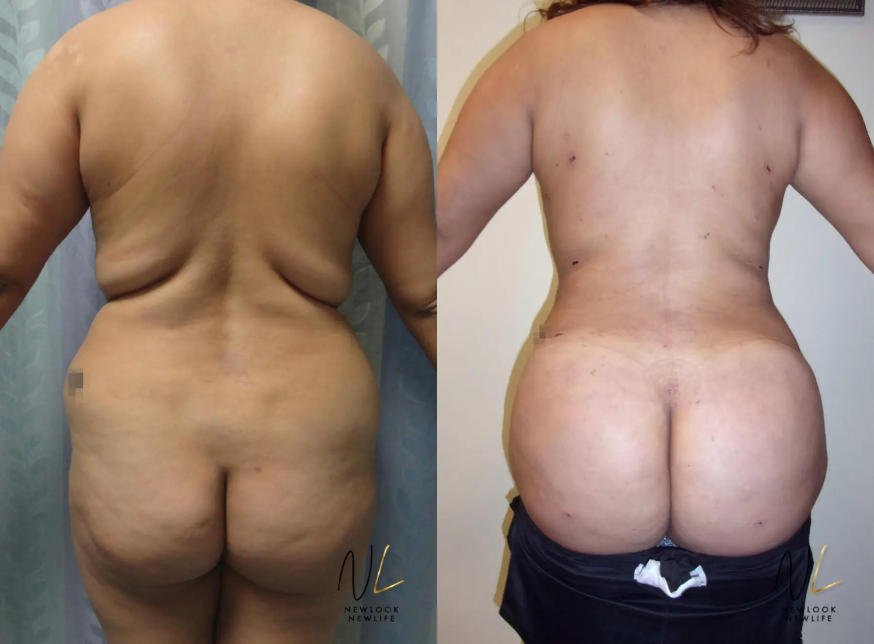 Brazilian Butt Lift: Patient 11 - Before and After 1