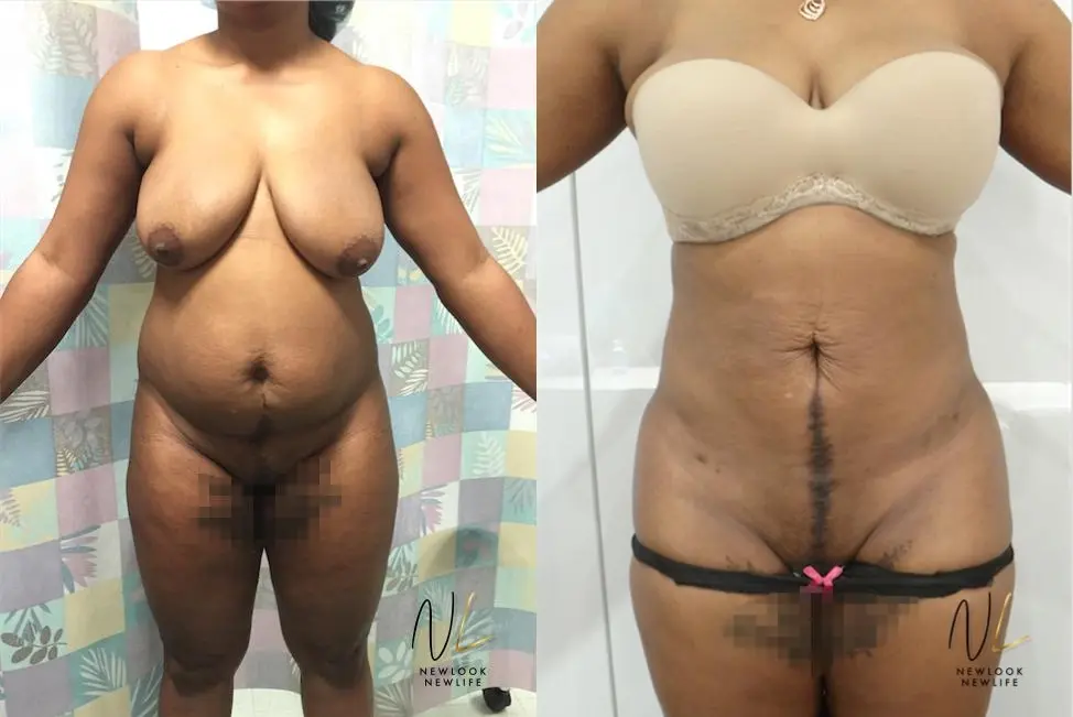 Brazilian Butt Lift: Patient 9 - Before and After 1