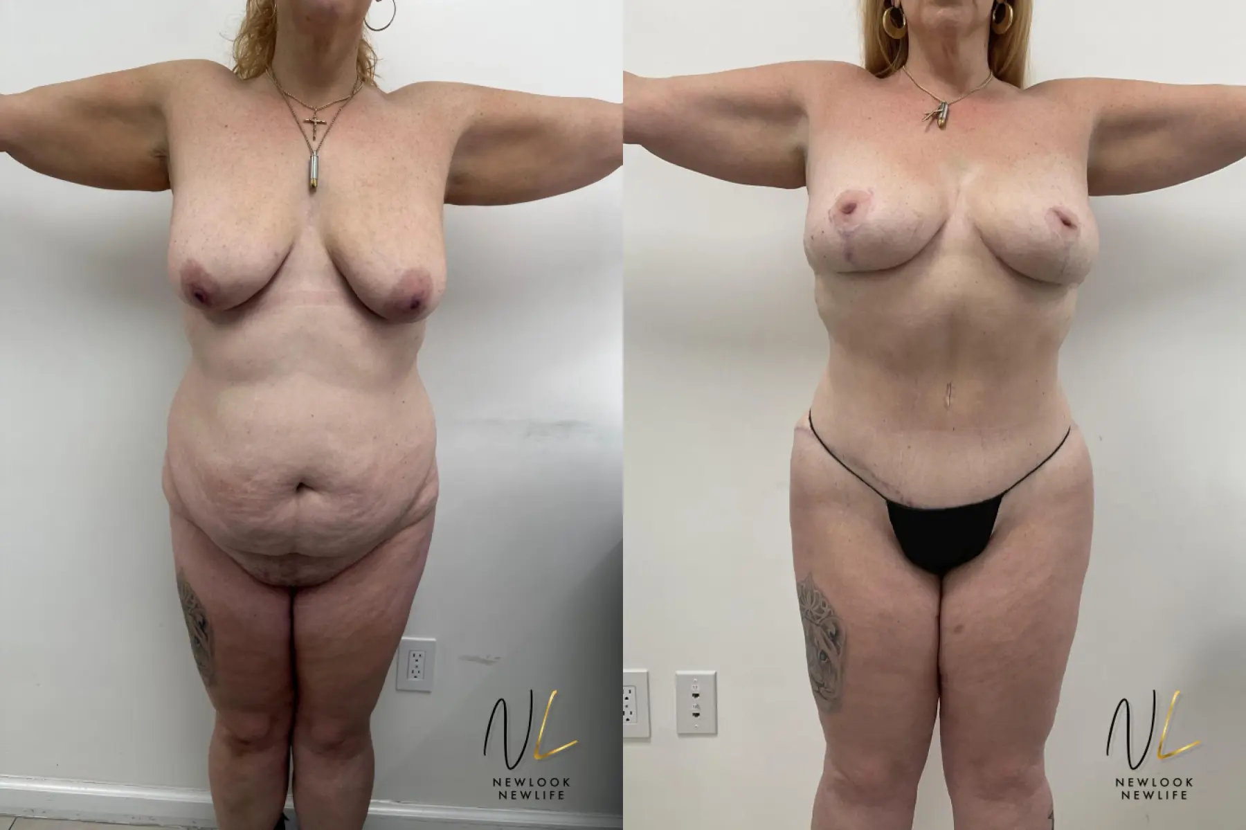 Brazilian Butt Lift: Patient 12 - Before and After 1