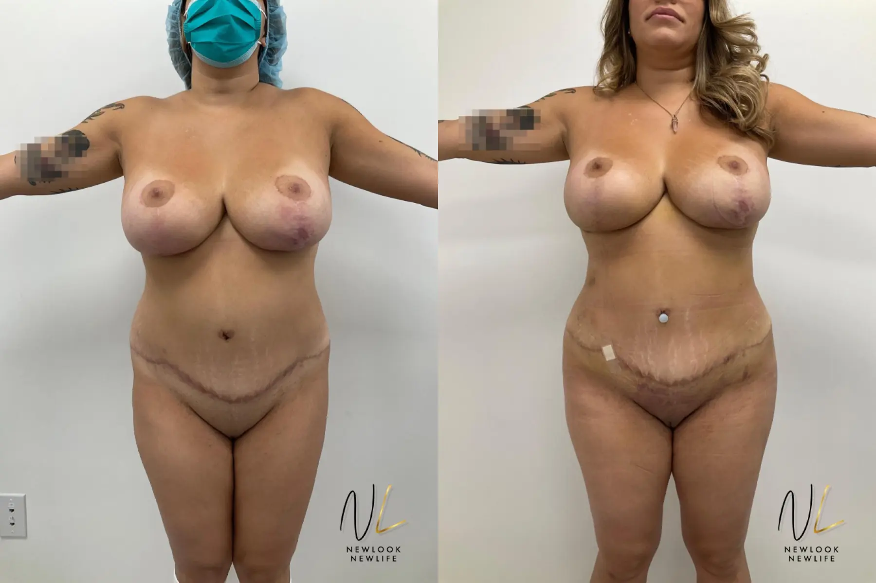 Brazilian Butt Lift: Patient 9 - Before and After  