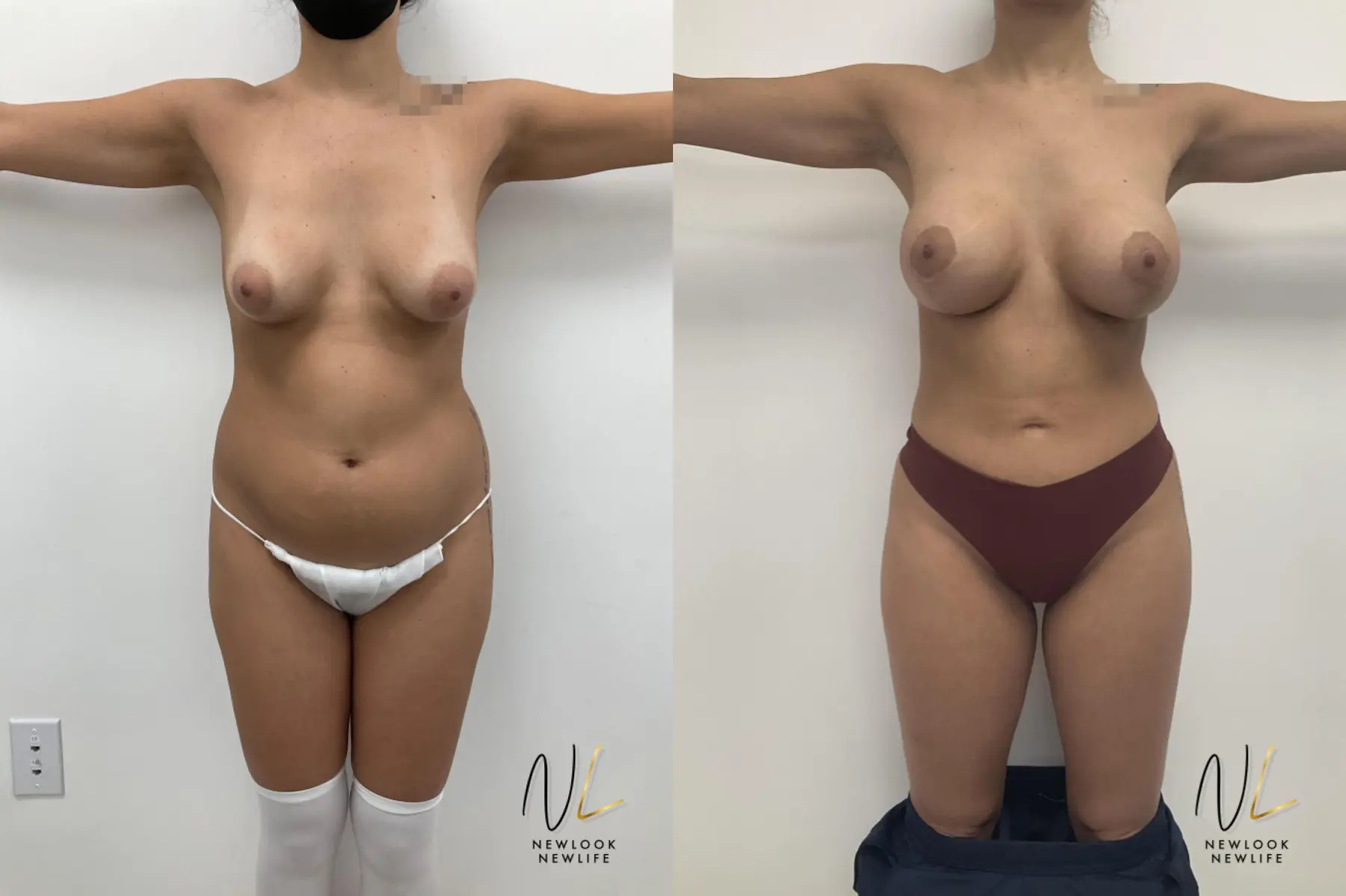 Brazilian Butt Lift: Patient 3 - Before and After  